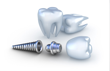 implant dentar ploiesti